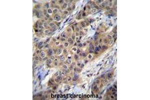 TGFB1 Antibody (N-term) immunohistochemistry analysis in formalin fixed and paraffin embedded human breast carcinoma followed by peroxidase conjugation of the secondary antibody and DAB staining. (TGFB1 Antikörper  (N-Term))