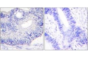 Immunohistochemistry analysis of paraffin-embedded human colon carcinoma tissue, using TGF alpha Antibody. (TGFA Antikörper  (AA 111-160))
