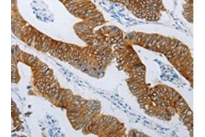 The image on the left is immunohistochemistry of paraffin-embedded Human colon cancer tissue using ABIN7192809(TMEM8B Antibody) at dilution 1/15, on the right is treated with synthetic peptide. (TMEM8B Antikörper)