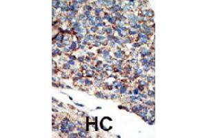 Formalin-fixed and paraffin-embedded human hepatocellular carcinoma tissue reacted with PIK3C2G polyclonal antibody  , which was peroxidase-conjugated to the secondary antibody, followed by AEC staining. (PIK3C2G Antikörper  (N-Term))
