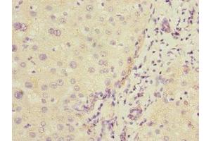 Immunohistochemistry of paraffin-embedded human liver cancer using ABIN7148298 at dilution of 1:100 (COMMD1 Antikörper  (AA 1-190))