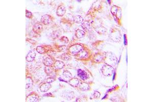 Immunohistochemical analysis of BMP5 staining in human lung cancer formalin fixed paraffin embedded tissue section. (BMP5 Antikörper  (Center))