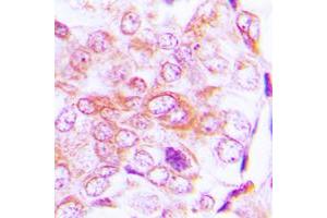 Immunohistochemical analysis of BMP5 staining in human lung cancer formalin fixed paraffin embedded tissue section.
