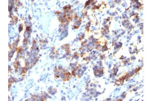 Formalin-fixed, paraffin-embedded human Gastric Carcinoma stained with MUC5AC Mouse Monoclonal Antibody (45M1). (MUC5AC Antikörper)