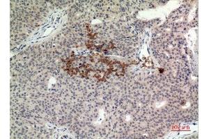 Immunohistochemistry (IHC) analysis of paraffin-embedded Human Breast Cancer, antibody was diluted at 1:100. (STING/TMEM173 Antikörper  (C-Term))