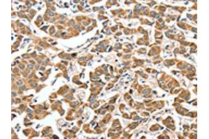 The image on the left is immunohistochemistry of paraffin-embedded Human breast cancer tissue using ABIN7189774(ALDH9A1 Antibody) at dilution 1/50, on the right is treated with synthetic peptide. (ALDH9A1 Antikörper)