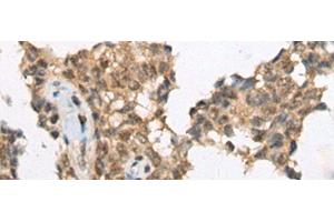 Immunohistochemistry of paraffin-embedded Human ovarian cancer tissue using ATRX Polyclonal Antibody at dilution of 1:50(x200) (ATRX Antikörper)