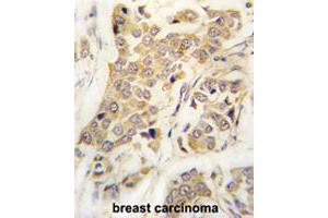 Formalin-fixed and paraffin-embedded human breast carcinomareacted with CDH8 polyclonal antibody , which was peroxidase-conjugated to the secondary antibody, followed by AEC staining. (Cadherin 8 Antikörper  (N-Term))