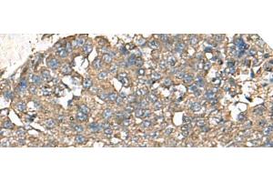 Immunohistochemistry of paraffin-embedded Human liver cancer tissue using RPS14 Polyclonal Antibody at dilution of 1:50(x200) (RPS14 Antikörper)
