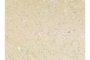ABIN6260529 and ABIN6279318 at 1/100 staining human glioblastoma by IHC-P. (CCDC8 Antikörper  (N-Term))