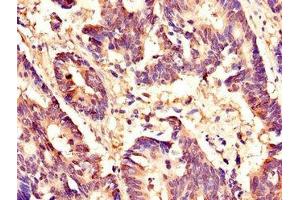 Immunohistochemistry of paraffin-embedded human colon cancer using ABIN7155909 at dilution of 1:100 (HCFC1 Antikörper  (AA 201-428))