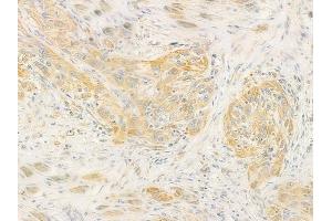 ABIN6260159 and ABIN6278363 at 1/100 staining human tongue carcinoma by IHC-P.