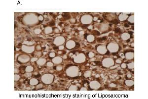 Immunohistochemical staining of liposarcoma cells using CYP26A1  antibody . (CYP26A1 Antikörper  (C-Term))
