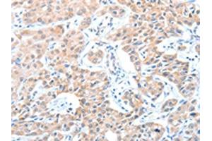The image on the left is immunohistochemistry of paraffin-embedded Human lung cancer tissue using ABIN7128233(ADAM21 Antibody) at dilution 1/15, on the right is treated with fusion protein. (ADAM21 Antikörper)