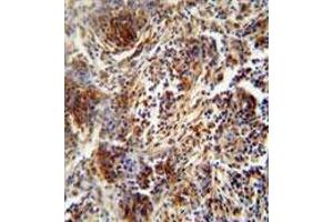 ZNF30 antibody (N-term) immunohistochemistry analysis in formalin fixed and paraffin embedded human lung carcinoma followed by peroxidase conjugation of the secondary antibody and DAB staining. (ZFP30 Antikörper  (N-Term))