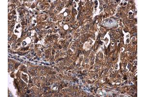 IHC-P Image CYP27A1 antibody detects CYP27A1 protein at cytoplasm in human endometrial carcinoma by immunohistochemical analysis. (CYP27A1 Antikörper  (Center))