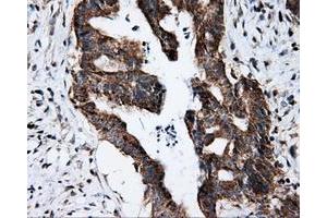 Immunohistochemical staining of paraffin-embedded Adenocarcinoma of colon tissue using anti-FKBP1A mouse monoclonal antibody. (FKBP1A Antikörper)
