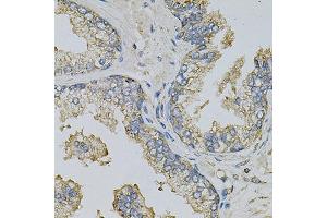 Immunohistochemistry of paraffin-embedded human prostate using PSAT1 Antibody (ABIN6293473) at dilution of 1:100 (40x lens). (PSAT1 Antikörper)