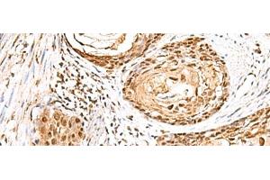 Immunohistochemistry of paraffin-embedded Human esophagus cancer tissue using ELF3 Polyclonal Antibody at dilution of 1:95(x200) (ELF3 Antikörper)