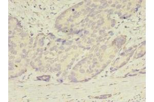 Immunohistochemistry of paraffin-embedded human gastric cancer using ABIN7145113 at dilution of 1:100 (ATG2B Antikörper  (AA 1357-1536))