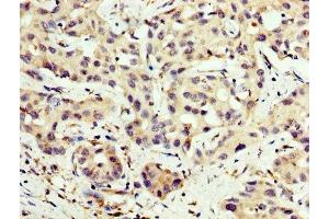 IHC image of ABIN7146841 diluted at 1:200 and staining in paraffin-embedded human liver cancer performed on a Leica BondTM system. (CPT2 Antikörper  (AA 388-551))