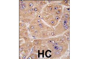 Formalin-fixed and paraffin-embedded human hepatocarcinoma tissue reacted with FUCA2 antibody , which was peroxidase-conjugated to the secondary antibody, followed by DAB staining.
