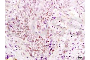 Formalin-fixed and paraffin embedded human esophageal carcinoma labeled with Anti-PAX3 Polyclonal Antibody, Unconjugated (ABIN737616) at 1:200 followed by conjugation to the secondary antibody and DAB staining (Paired Box 3 Antikörper  (AA 151-250))
