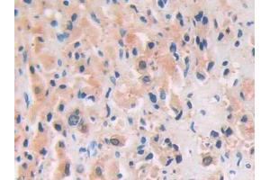 DAB staining on IHC-P; Samples: Human Prostate cancer Tissue (PRSS8 Antikörper  (AA 33-218))
