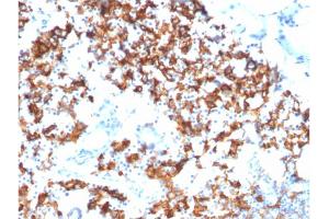 Formalin-fixed, paraffin-embedded human Gastric Carcinoma stained with IL3RA/CD123 Mouse Monoclonal Antibody (IL3RA/1531). (IL3RA Antikörper  (AA 26-171))