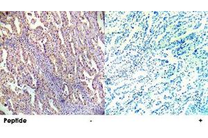 Immunohistochemical analysis of paraffin-embedded human lung carcinoma tissue using PRKAB1 polyclonal antibody . (PRKAB1 Antikörper  (Ser182))