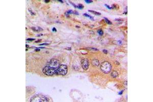 Immunohistochemical analysis of EEF2K staining in human lung cancer formalin fixed paraffin embedded tissue section. (EEF2K Antikörper  (Center))