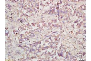 Formalin-fixed and paraffin embedded human lung carcinoma labeled with Rabbit Anti-V-ATPase A1 Polyclonal Antibody, Unconjugated (ABIN1387667) at 1:200 followed by conjugation to the secondary antibody and DAB staining (V-ATPase 116 kDa Isoform a1 (AA 41-140) Antikörper)