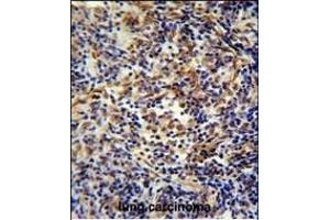 CASKIN2 Antibody (Center) (ABIN654902 and ABIN2844550) immunohistochemistry analysis in formalin fixed and paraffin embedded human lung carcinoma followed by peroxidase conjugation of the secondary antibody and DAB staining. (CASKIN2 Antikörper  (AA 714-741))