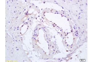 Formalin-fixed and paraffin embedded human gastric carcinoma labeled with Anti-Phospho-PPAR Gamma(ser112) Polyclonal Antibody, Unconjugated (ABIN703405) at 1:200, followed by conjugation to the secondary antibody and DAB staining (PPARG Antikörper  (pSer112))