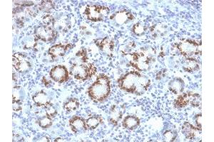 Formalin-fixed, paraffin-embedded human Gastric Carcinoma stained with SOX9 Mouse Monoclonal Antibody (SOX9/2387). (SOX9 Antikörper  (AA 393-508))
