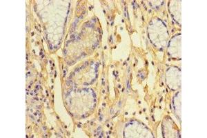 Immunohistochemistry of paraffin-embedded human gastric cancer using ABIN7163422 at dilution of 1:100 (ANKRD33 Antikörper  (AA 1-272))