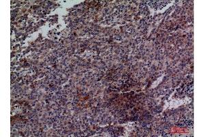 Immunohistochemistry (IHC) analysis of paraffin-embedded Human Lung Cancer, antibody was diluted at 1:100. (CDC34 Antikörper  (Internal Region))