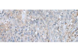 Immunohistochemistry of paraffin-embedded Human lung cancer tissue using VWA2 Polyclonal Antibody at dilution of 1:45(x200)