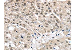 The image on the left is immunohistochemistry of paraffin-embedded Human breast cancer tissue using ABIN7130212(MED15 Antibody) at dilution 1/30, on the right is treated with fusion protein. (MED15 Antikörper)