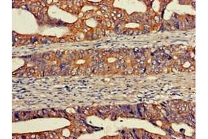 Immunohistochemistry of paraffin-embedded human colon cancer using ABIN7152131 at dilution of 1:100 (EIF2S1 Antikörper  (AA 276-315))