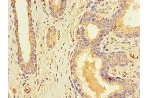 Immunohistochemistry of paraffin-embedded human prostate cancer using ABIN7168091 at dilution of 1:100 (Riboflavin Kinase Antikörper  (AA 1-154))