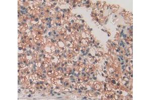 Used in DAB staining on fromalin fixed paraffin- embedded kidney cancer tissue