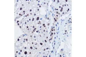 Immunohistochemistry of paraffin-embedded human liver cancer using  Rabbit pAb (ABIN7265580) at dilution of 1:150 (40x lens). (ANAPC11 Antikörper  (AA 1-84))