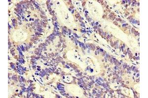 Immunohistochemistry of paraffin-embedded human colon cancer using ABIN7176555 at dilution of 1:100 (ZNF844 Antikörper  (AA 1-300))