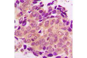 Immunohistochemical analysis of ALDOB staining in human breast cancer formalin fixed paraffin embedded tissue section. (ALDOB Antikörper  (Center))