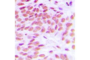 Immunohistochemical analysis of GATA1 staining in human breast cancer formalin fixed paraffin embedded tissue section. (GATA1 Antikörper  (Center))