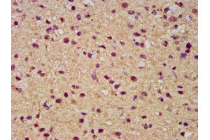 IHC image of ABIN7171980 diluted at 1:300 and staining in paraffin-embedded human glioma performed on a Leica BondTM system. (SLC19A2 Antikörper  (AA 209-285))