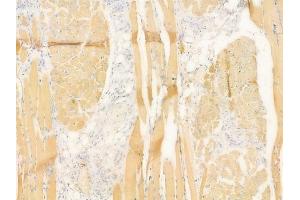 ABIN6258196 and ABIN6273901 at 1/100 staining human tongue carcinoma by IHC-P.