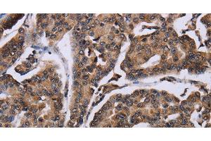 Immunohistochemistry of paraffin-embedded Human breast cancer using KIF1C Polyclonal Antibody at dilution of 1:60 (KIF1C Antikörper)