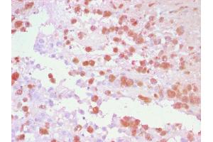 Formalin-fixed, paraffin-embedded human Melanoma stained with TYRP1 Rabbit Polyclonal Antibody using AEC Chromogen (red). (Tyrosinase-Related Protein 1 Antikörper)